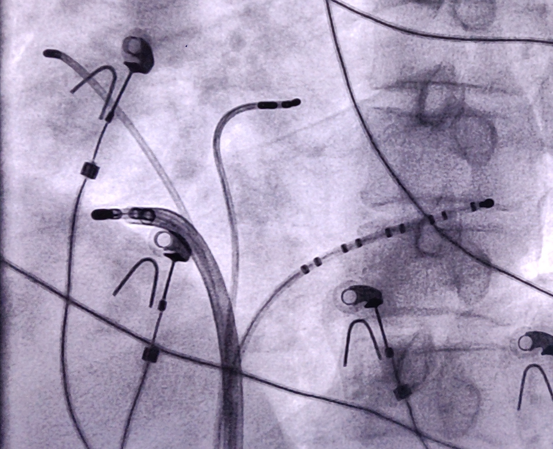 09_ablation site.jpg
